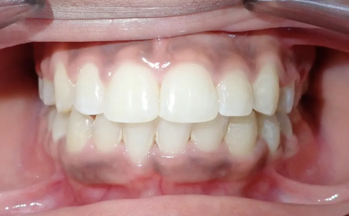Ca chỉnh nha 1, sau điều trị