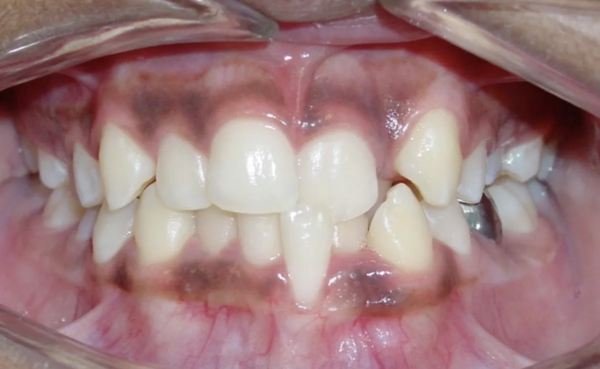 Ca chỉnh nha 1, trước điều trị