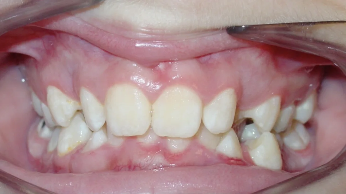 Ca chỉnh nha 2, trước điều trị