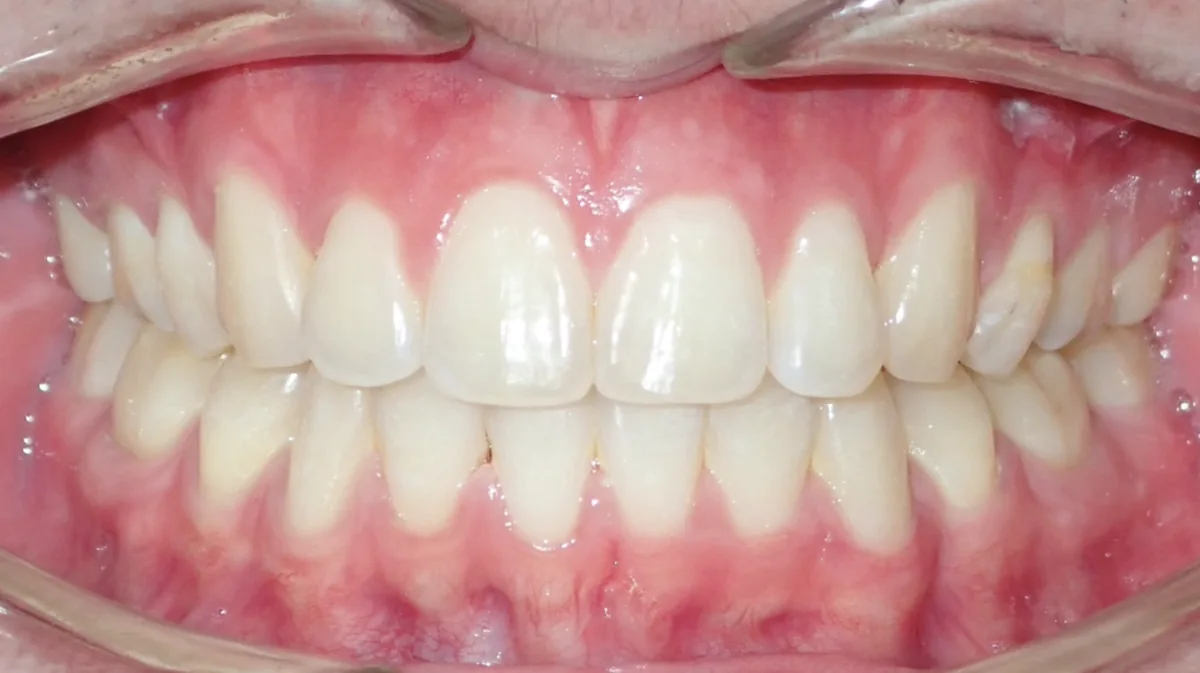Orthodontic case 3, after treatment