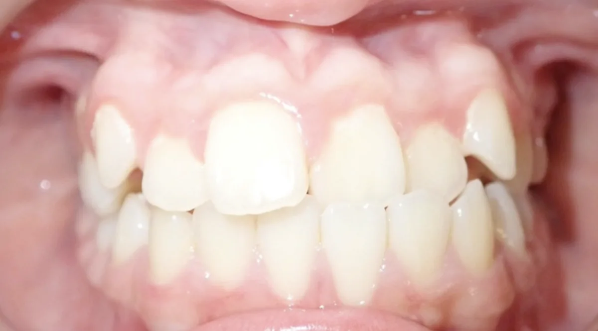 Orthodontic case 3, before treatment