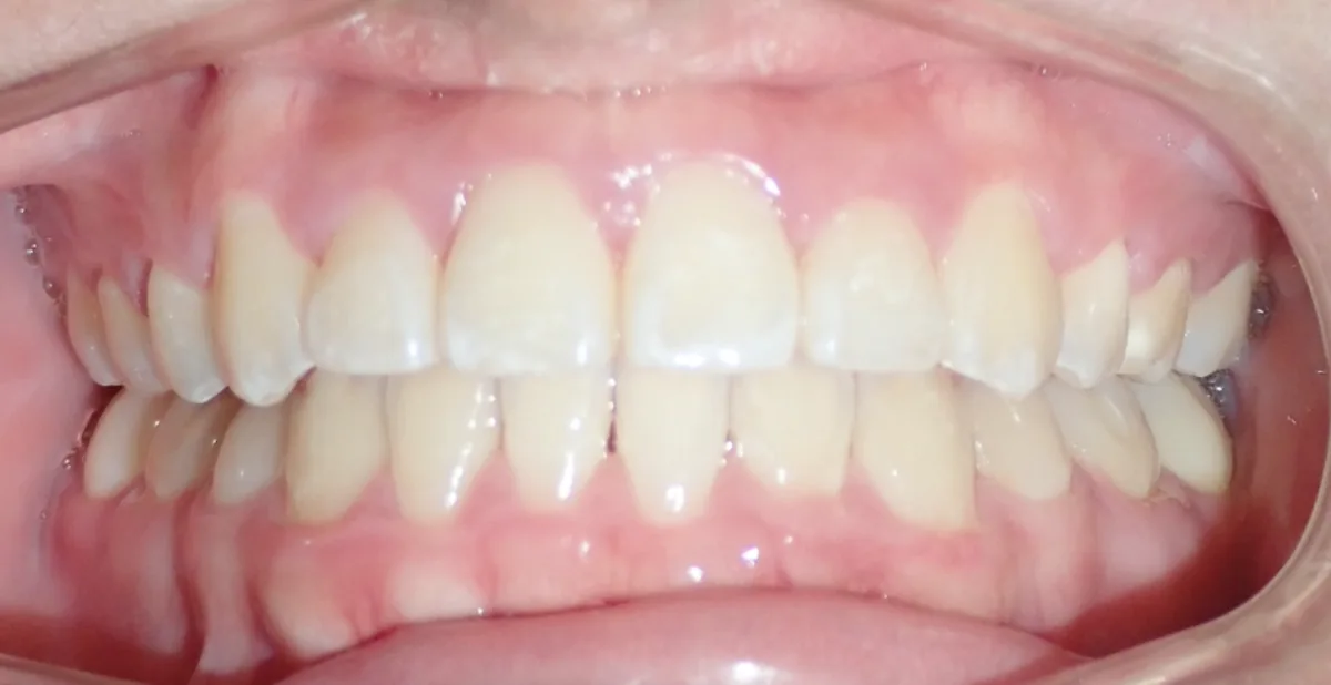 Orthodontic case 4, after treatment