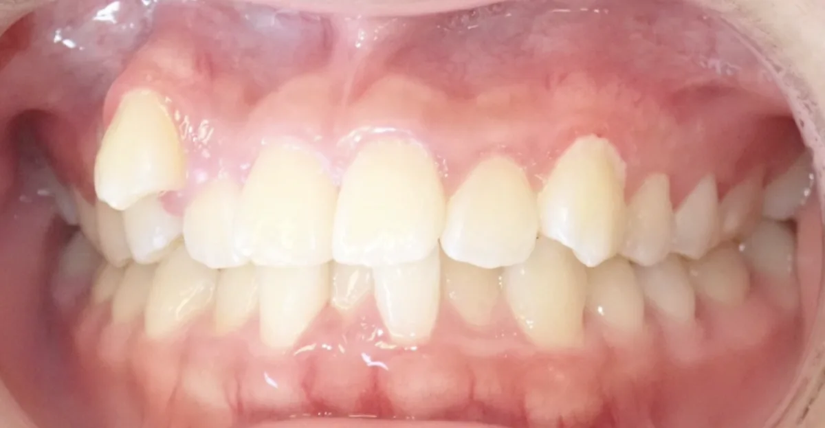 Orthodontic case 4, before treatment