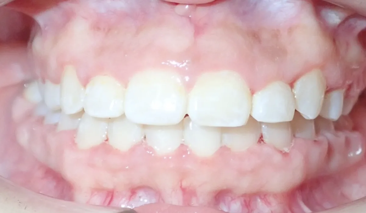 Orthodontic case 7, after treatment