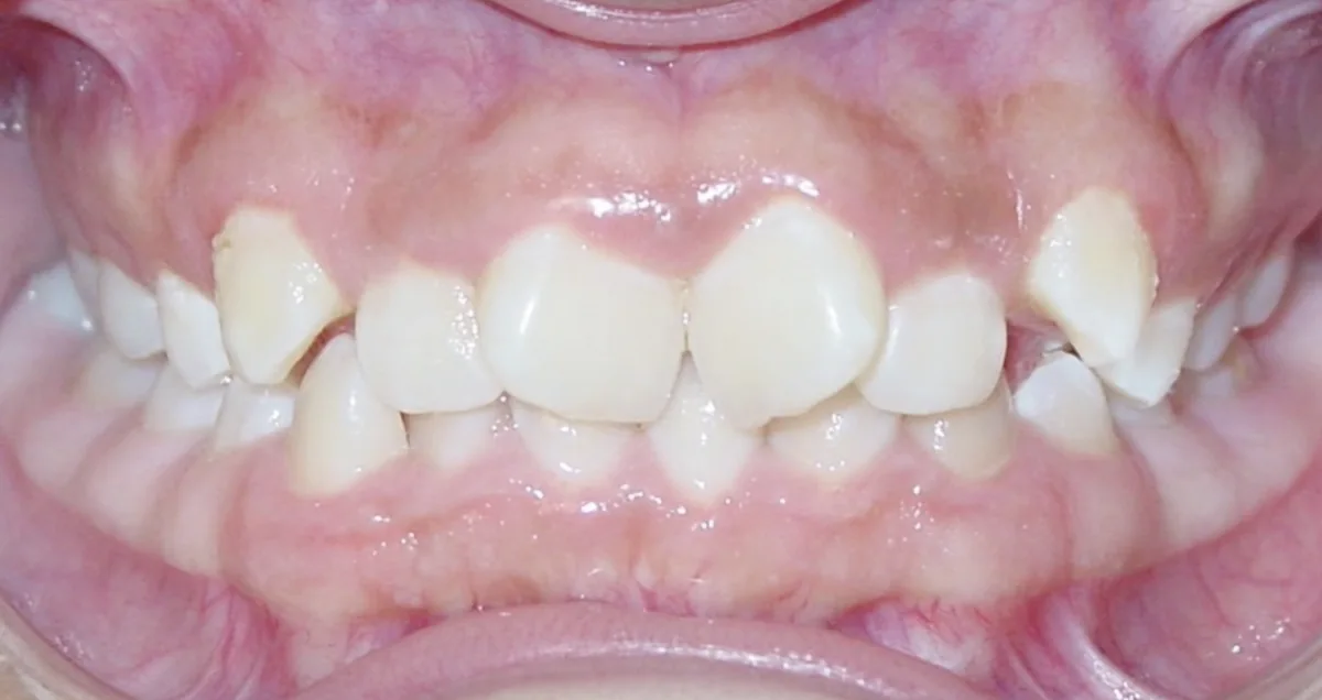 Orthodontic case 7, before treatment