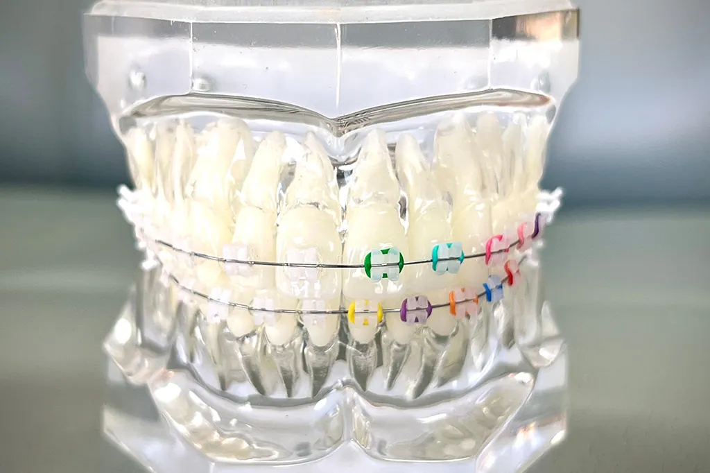 LightForce clear braces at iCare Orthodontics in Norcross