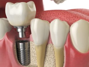 Graphic of a dental implant